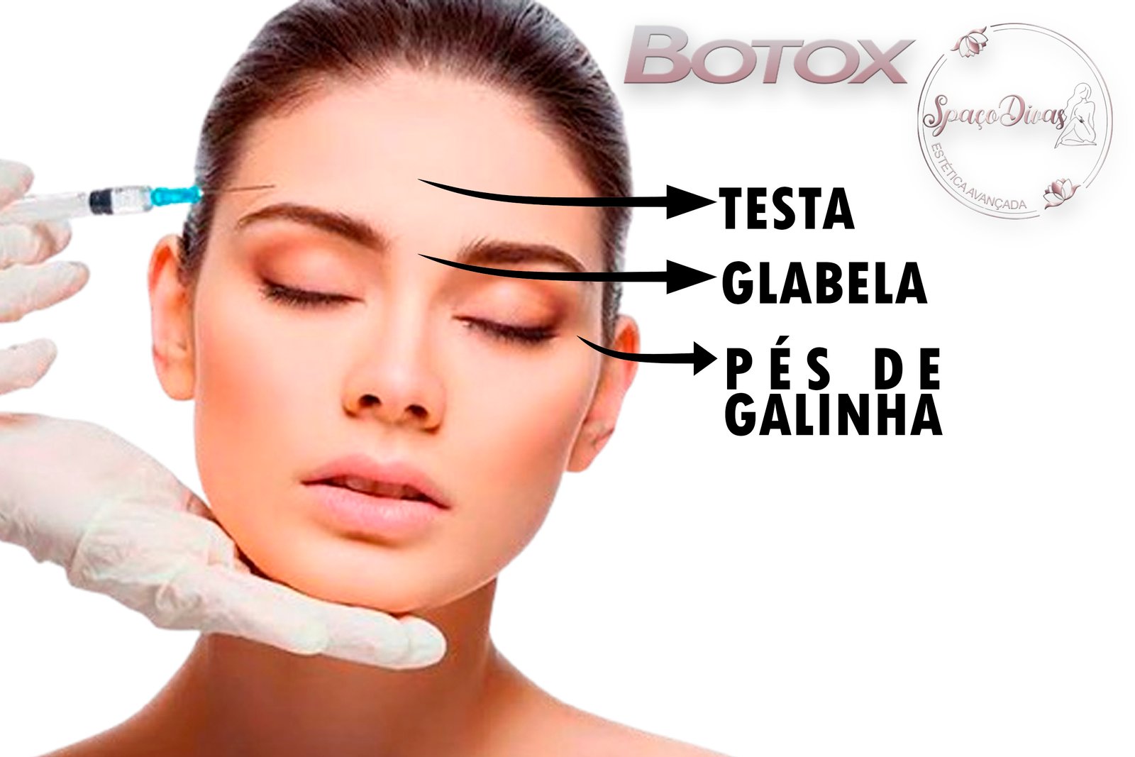 01 APLICAÇÃO DE BOTOX (ROSTO) + PREENCHIMENTO